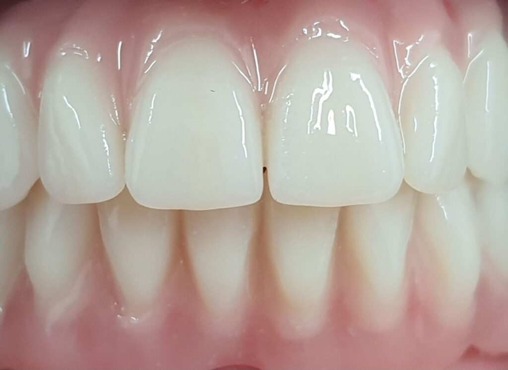 Differenza tra Protesi Mobile e Impianto Dentale Fisso 2 differenza tra protesi mobile e impianto dentale fisso